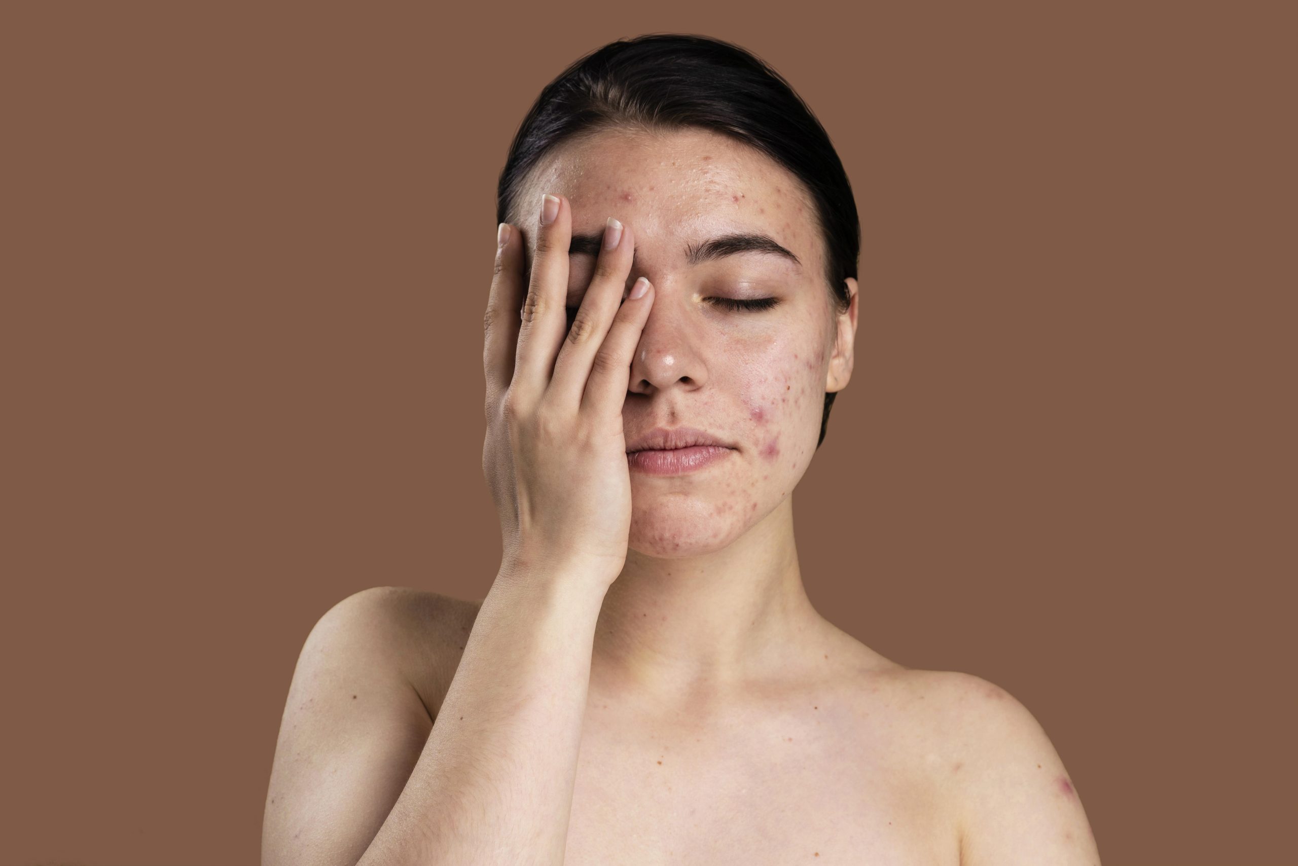Perjuangan Acne Fighter: Manusia Paling Tabah Melawan Jerawat