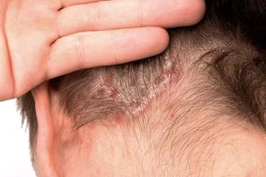 Psoriasis kulit kepala