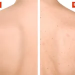 Cara Mengatasi Jerawat di Punggung Paling Ampuh!