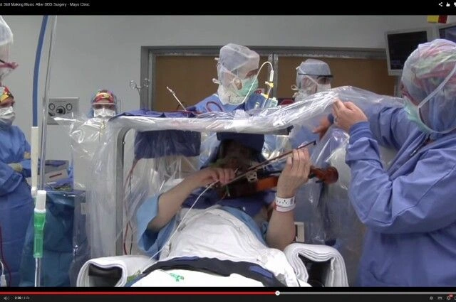 Pasien Sadar Saat Operasi Otak: Rahasia Keberhasilan Tinggi