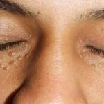 Mirip, Ini Cara Bedakan Syringoma dan Milia!