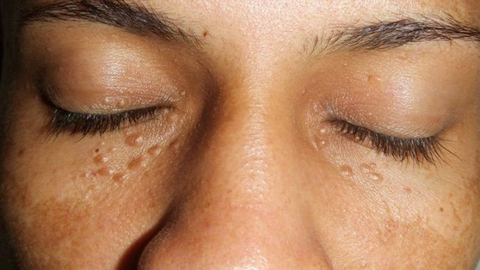 Mirip, Ini Cara Bedakan Syringoma dan Milia!