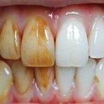 Amelogenesis Imperfecta: Gigi Rapuh Sejak Lahir, Ini Faktanya