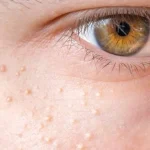 Syringoma di Wajah Sulit Hilang, Ini Fakta Medisnya