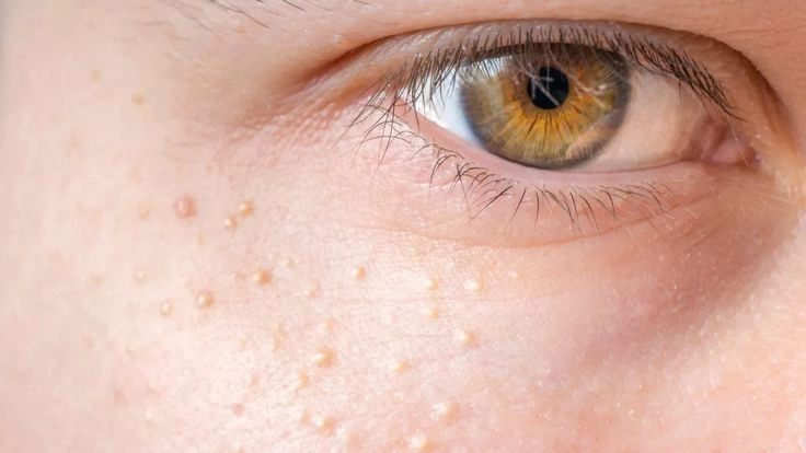 Syringoma di Wajah Sulit Hilang, Ini Fakta Medisnya